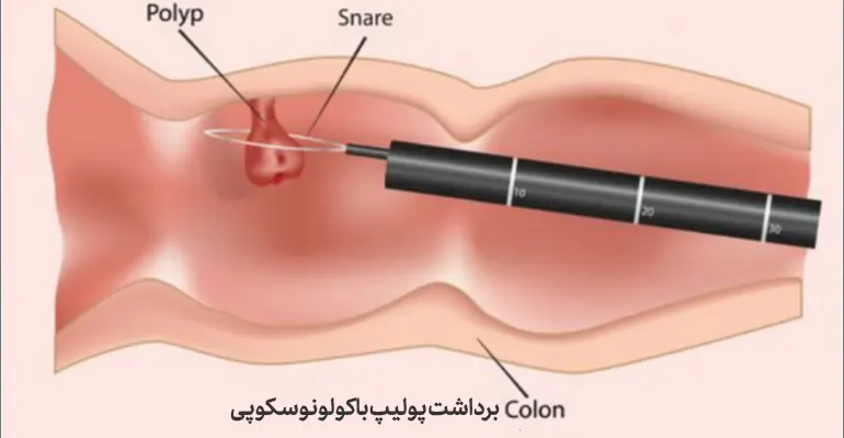 برداشت پولیپ روده با کولونوسکوپی