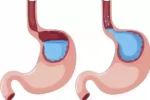 رژیم بیماران با مشکل معده و رفلاکس معده