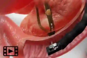 فیلم عمل ercp