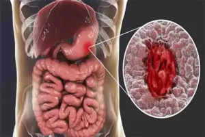 هر آنچه باید راجع به زخم معده بدانیم