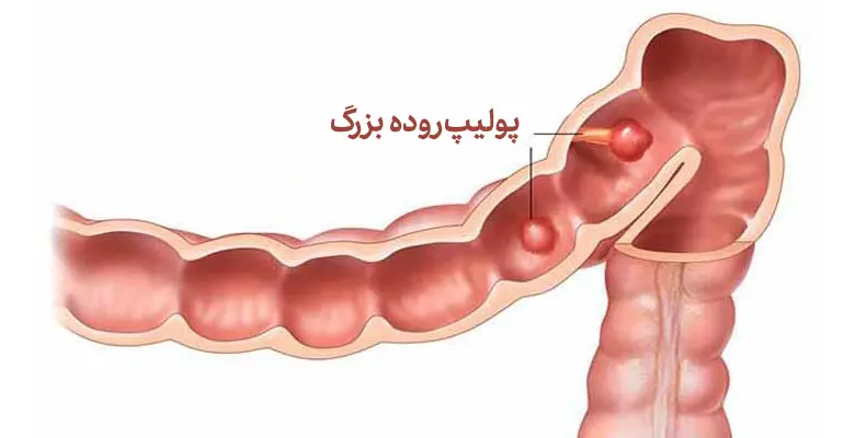 پولیپ روده بزرگ