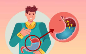 ریفلاکس معده چیست