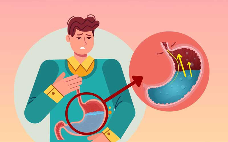 ریفلاکس معده چیست