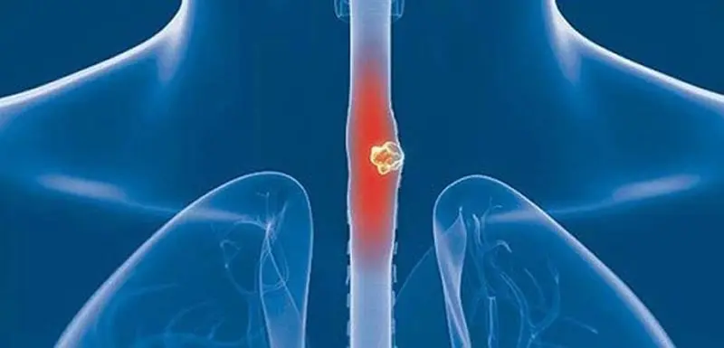 سرطان مری چیست