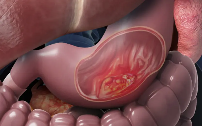 سرطان معده چیست؟