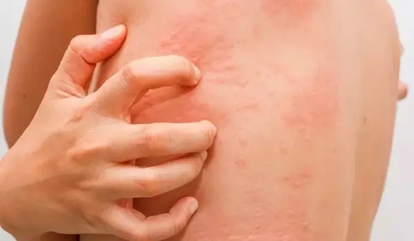 بیماری سلیاک و علائم آن