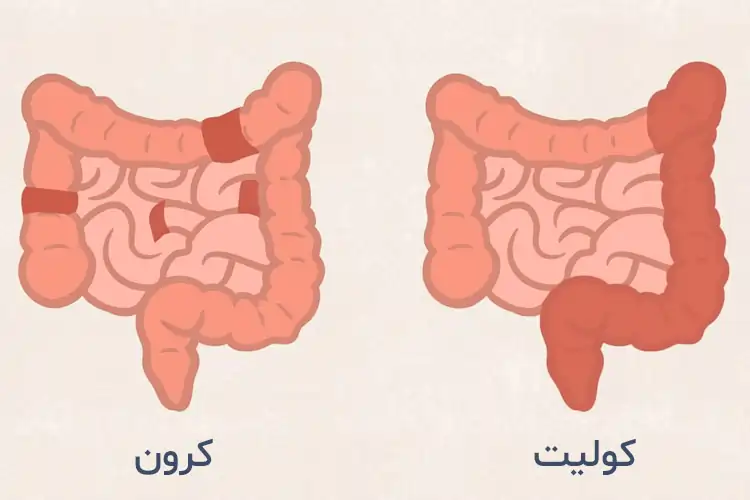 تفاوت کولیت کرون چیست