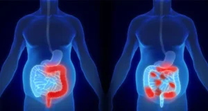 علائم کولیت اولسراتیو و کرون