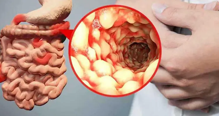 رژیم غذایی کولیت اولسراتیو و بیماری کرون