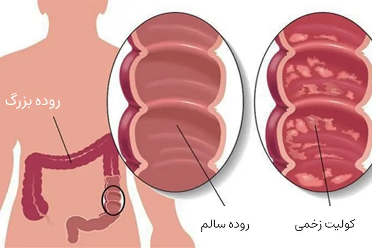 کولیت اولسراتیو و بیماری کرون