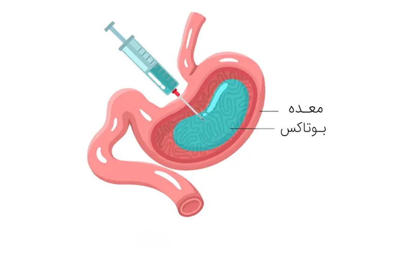 بوتاک معده در بیمارستان